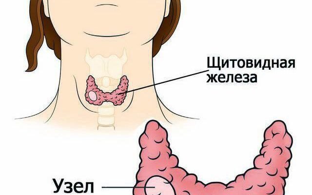 Дифузно-вогнищеві зміни щитовидної залози: симптоми та лікування