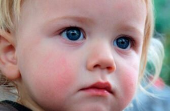 Лопають капіляри на обличчі у дитини: причини та лікування