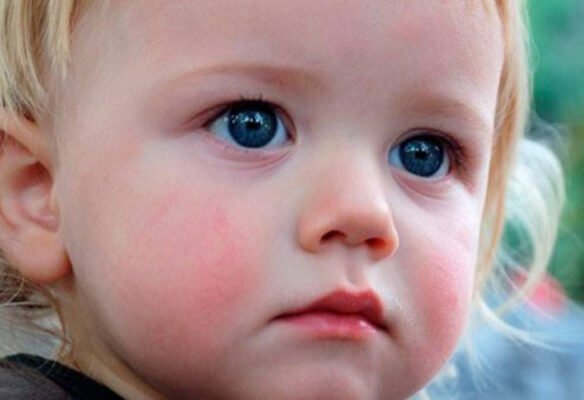 Лопають капіляри на обличчі у дитини: причини та лікування