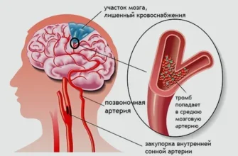 Хвороба судин головного мозку: симптоми, лікування, профілактика