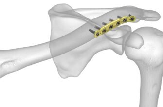 Вартість операції при переломі ключиці: що потрібно знати пацієнтам