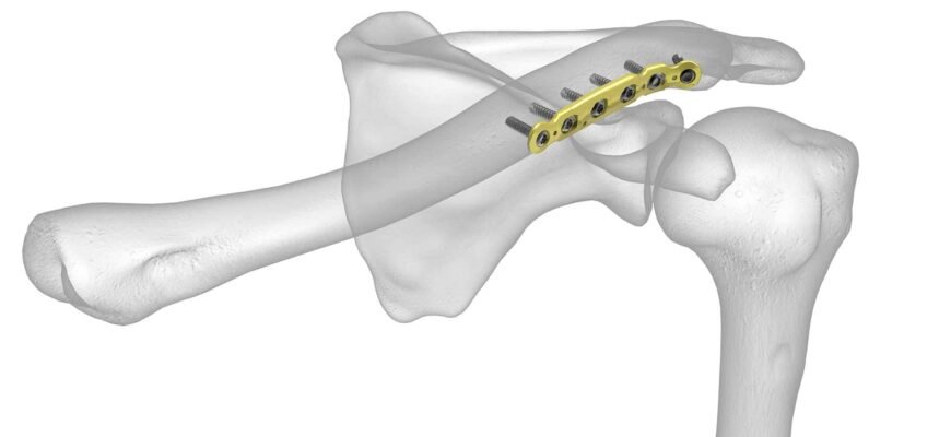 Вартість операції при переломі ключиці: що потрібно знати пацієнтам