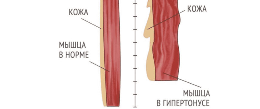 Гіпертонус м’язів у дитини 2 роки: діагностика та поради батькам
