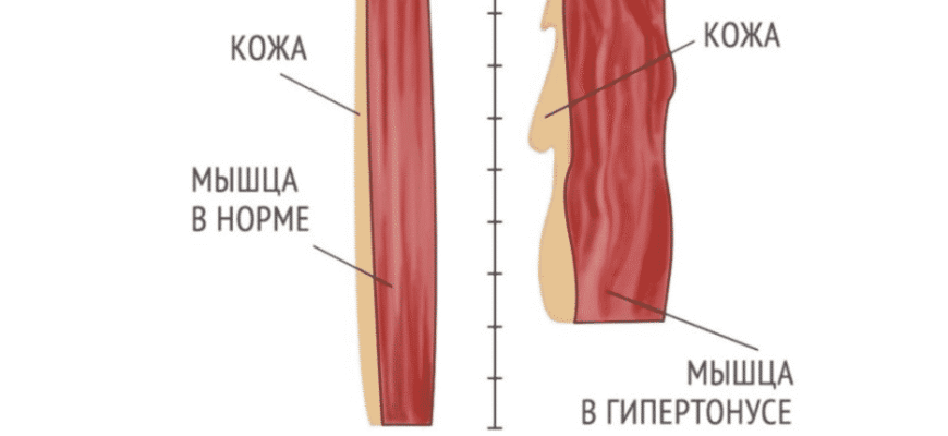 Гіпертонус м’язів у дитини 2 роки: діагностика та поради батькам Гіпертонус м’язів у дитини 2 роки: діагностика та поради батькам
