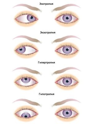 Що робити, якщо у дитини косить одне око: поради батькам