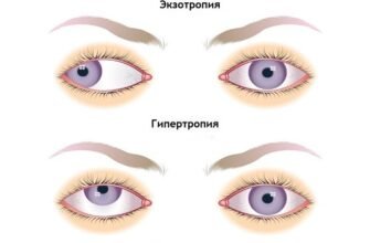 Що робити, якщо у дитини косить одне око: поради батькам