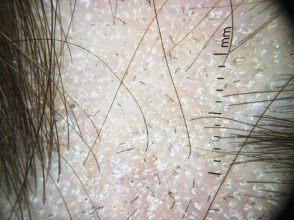 Лишай на голові у дитини: причини, симптоми та методи лікування