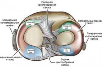 Дегенеративні зміни медіального меніска: причини та лікування