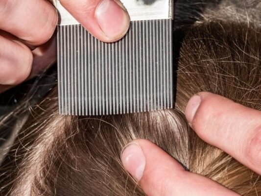 Як вивести воші у дитини: ефективні та безпечні методи боротьби