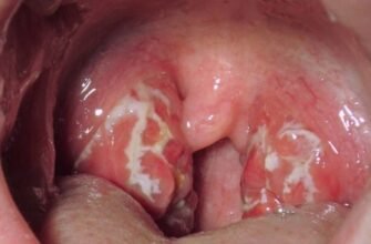 Збільшені аденоїди у дитини: основні симптоми та що робити