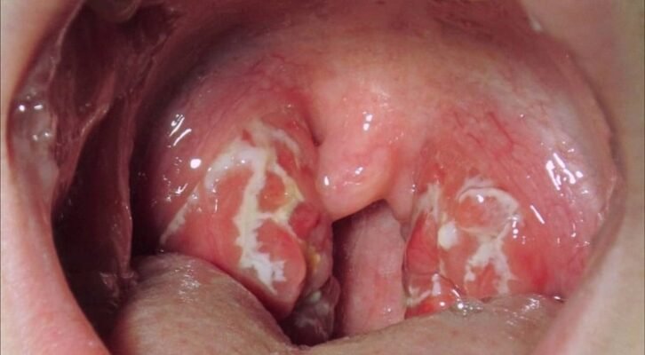 Збільшені аденоїди у дитини: основні симптоми та що робити