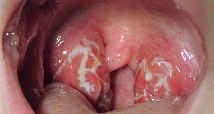 Збільшені аденоїди у дитини: основні симптоми та що робити