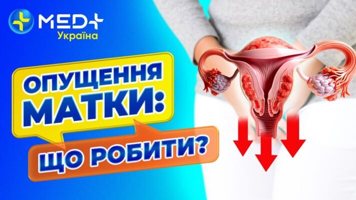 Вправи Кегеля при опущенні матки: відео та поради для жінок