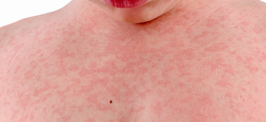 Як виглядає лишай у дитини: основні ознаки та симптоми Як виглядає лишай у дитини: основні ознаки та симптоми