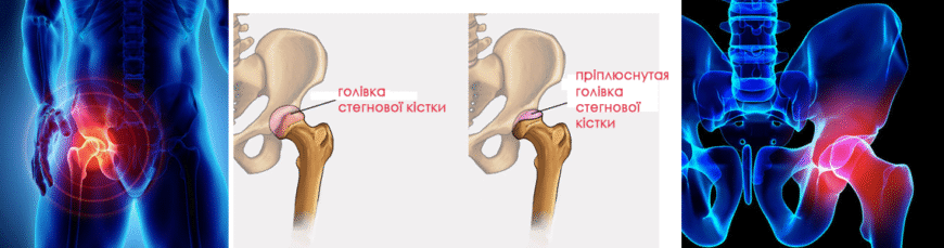 Хвороба Пертеса у дітей: симптоми, діагностика та лікування