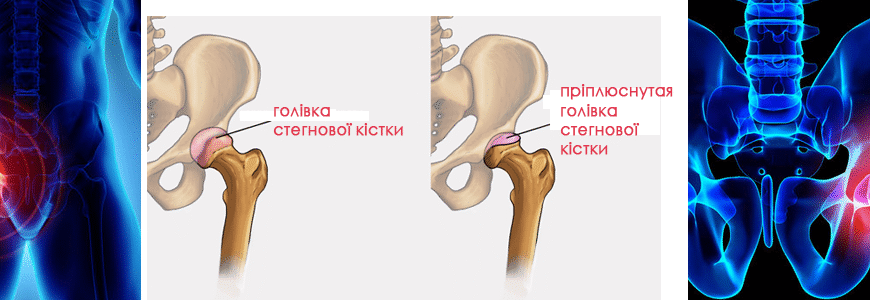 Хвороба Пертеса у дітей: симптоми, діагностика та лікування