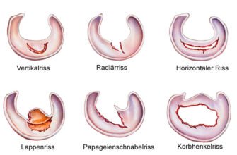 Дегенеративні зміни меніска: причини, симптоми та лікування