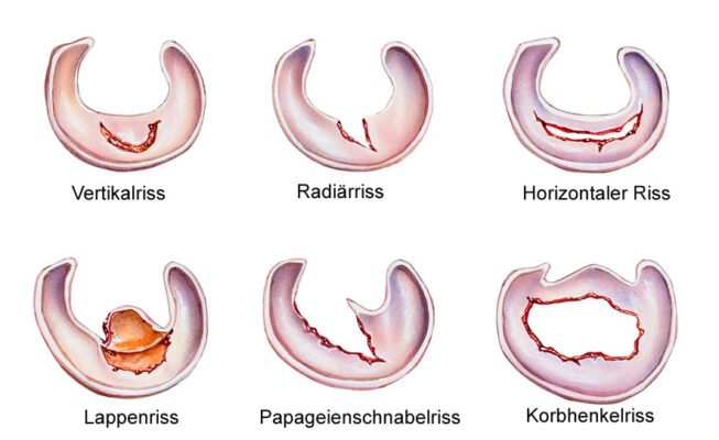 Дегенеративні зміни меніска: причини, симптоми та лікування