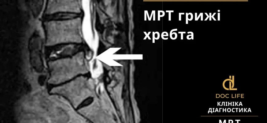 Знеболюючі при грижі хребта: огляд ефективних препаратів та методів