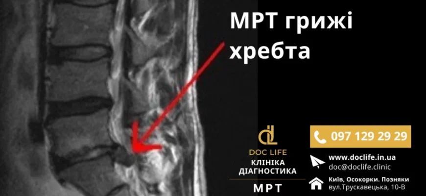 Чи дають інвалідність при грижі хребта: умови та критерії оцінки