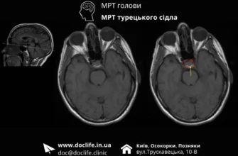 Кортико атрофічні зміни головного мозку: причини та наслідки розвитку