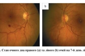 Фонова ретинопатія: причини та зміни в ретинальних судинах