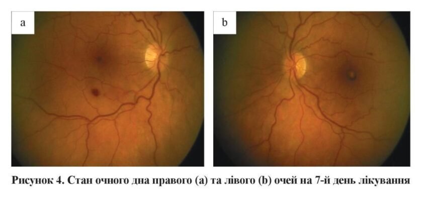Фонова ретинопатія: причини та зміни в ретинальних судинах Фонова ретинопатія: причини та зміни в ретинальних судинах