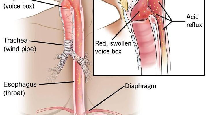 Біль при ковтанні в стравоході: причини, діагностика, лікування