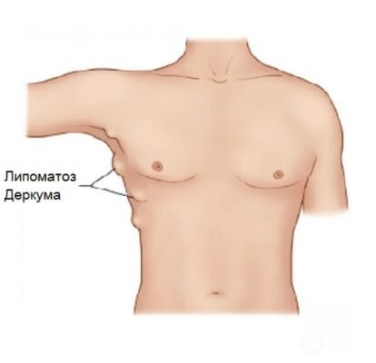 Хвороба Деркума: симптоми, причини та методи лікування захворювання Хвороба Деркума: симптоми, причини та методи лікування захворювання