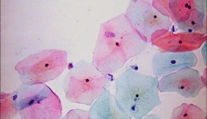 Що таке реактивні зміни епітелію: причини та наслідки для здоров’я Що таке реактивні зміни епітелію: причини та наслідки для здоров’я