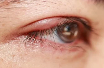 Халязіон у дитини: причини, симптоми та ефективне лікування