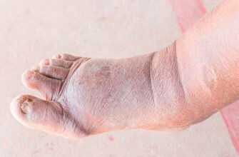 Оніміння ніг при цукровому діабеті: причини та методи лікування