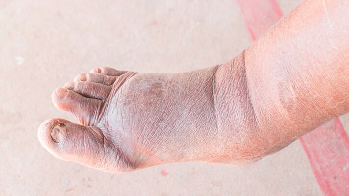 Оніміння ніг при цукровому діабеті: причини та методи лікування