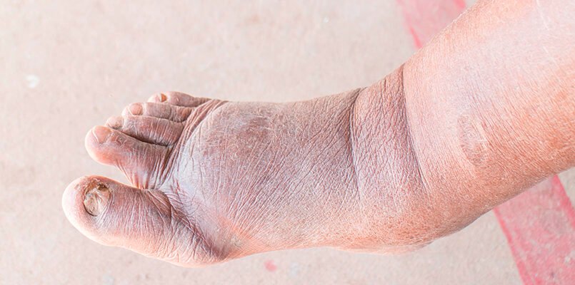 Оніміння ніг при цукровому діабеті: причини та методи лікування