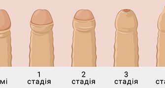 Фімоз у дитини: симптоми, причини та методи лікування