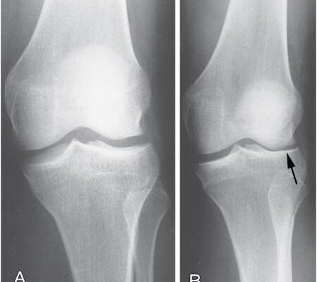 Хвороба Шляттера це: симптоми, діагностика та лікування