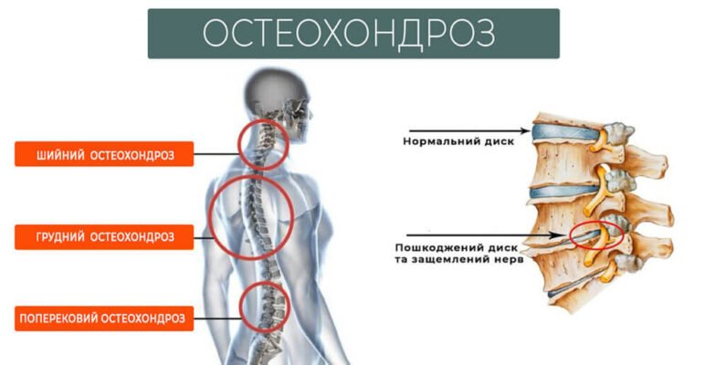 Дистрофічні зміни хребта: причини, симптоми та лікування