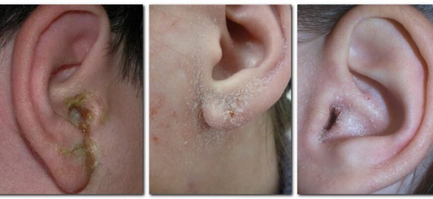 Чи можна капати перекис водню у вухо при отиті: медичні поради