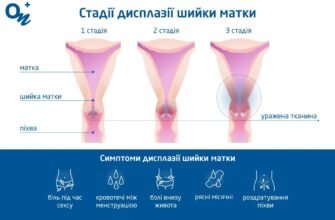 Чи можна завагітніти при дисплазії шийки матки: факти та поради лікарів