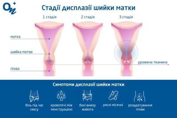 Чи можна завагітніти при дисплазії шийки матки: факти та поради лікарів
