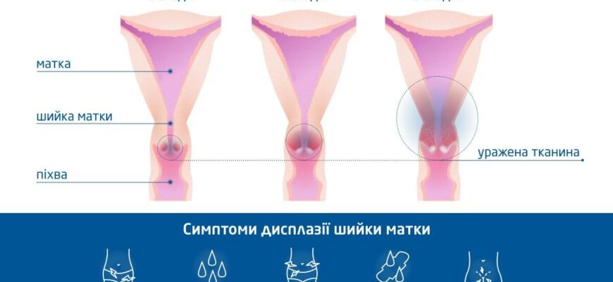 Чи можна завагітніти при дисплазії шийки матки: факти та поради лікарів