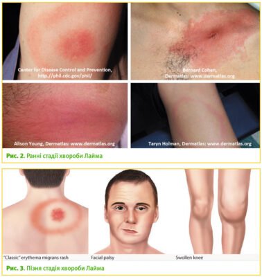Чи виліковується хвороба Лайма: відповіді на важливі питання