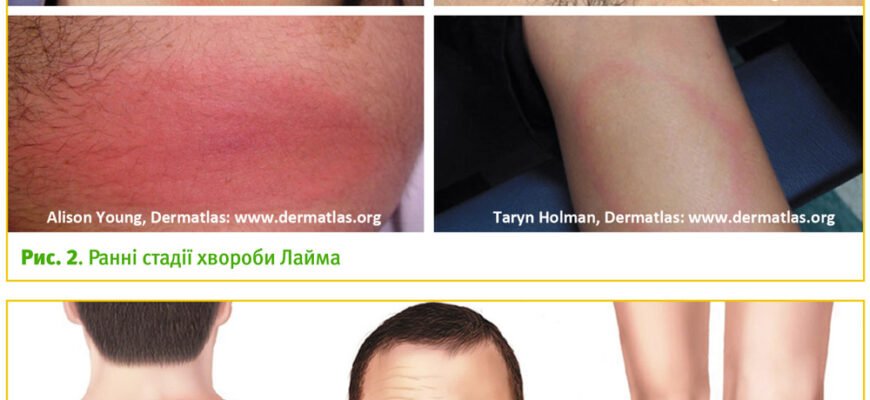 Чи виліковується хвороба Лайма: відповіді на важливі питання