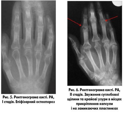 Кістково деструктивні зміни: що це і як їх розпізнати?