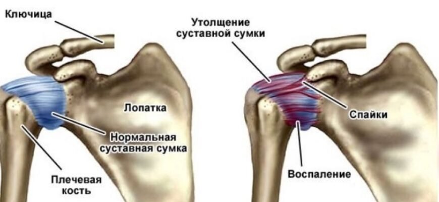 Біль в плечовому суглобі при підйомі руки: причини та лікування
