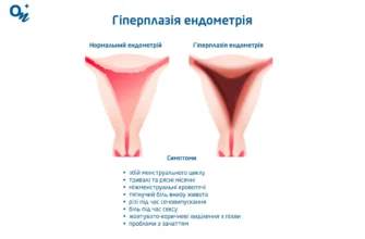 Місячні при гіперплазії ендометрію: симптоми та лікування