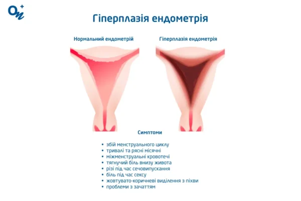 Місячні при гіперплазії ендометрію: симптоми та лікування