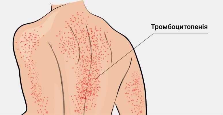 Тромбоцити підвищені у дитини: причини та методи лікування