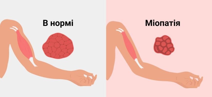Хвороба Дюшена: Симптоми, які важливо знати для раннього виявлення