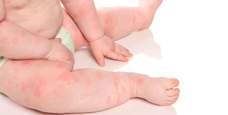 Алергічний висип у дитини: причини, симптоми та лікування